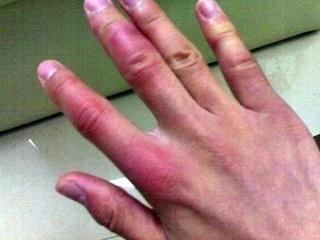 明星谁手冻疮,揭秘明星冬季护肤秘籍